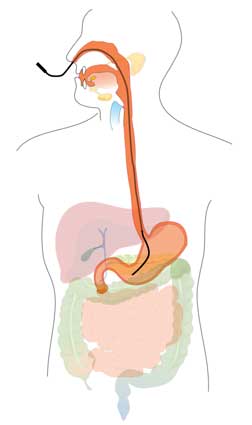 diagram of a human body showing Nasogastric Tube Diagram inserted through the nose and running ot the stomach