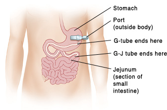 Diagram showing the relative placement of the G-Tube and GJ ports