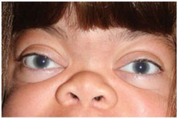 Close-up of a child's face showing Corneal clouding