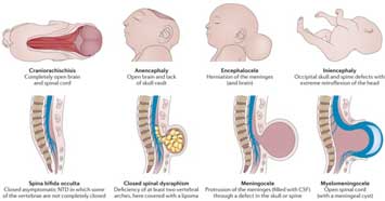 Thumbnails of illustrations of myelomeningocele, meningocele, and spina bifida occulta