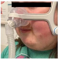 Close-up of a nasal pillow PAP mask on a young girl with sleep apnea